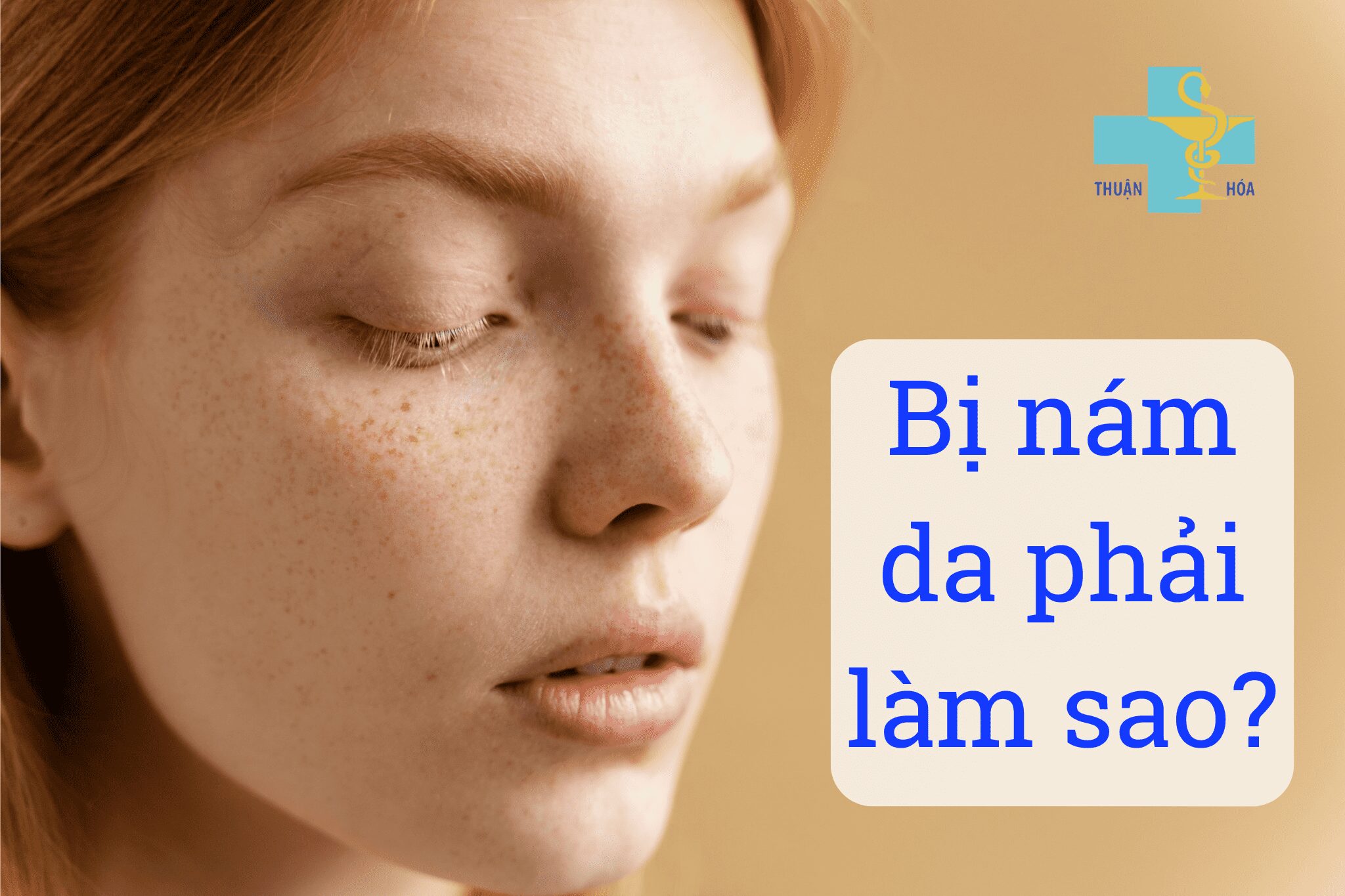 Bị nám da phải làm sao - Nám da mặt là gì?