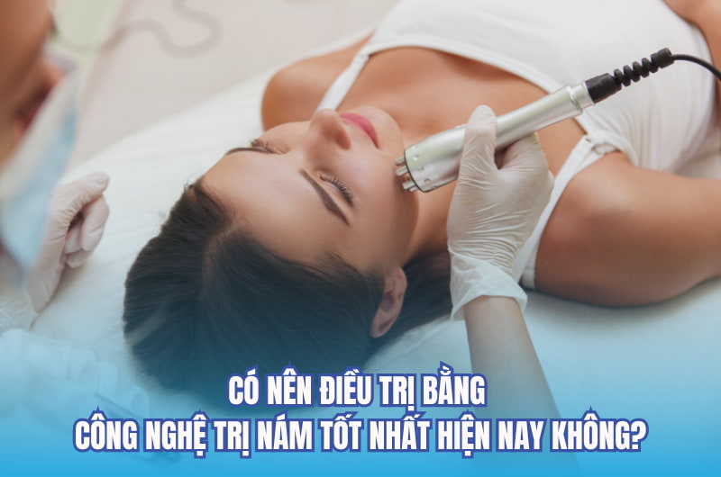 Công nghệ trị nám tốt nhất hiện nay