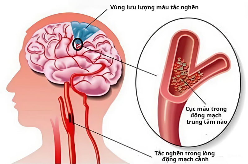 đột quỵ