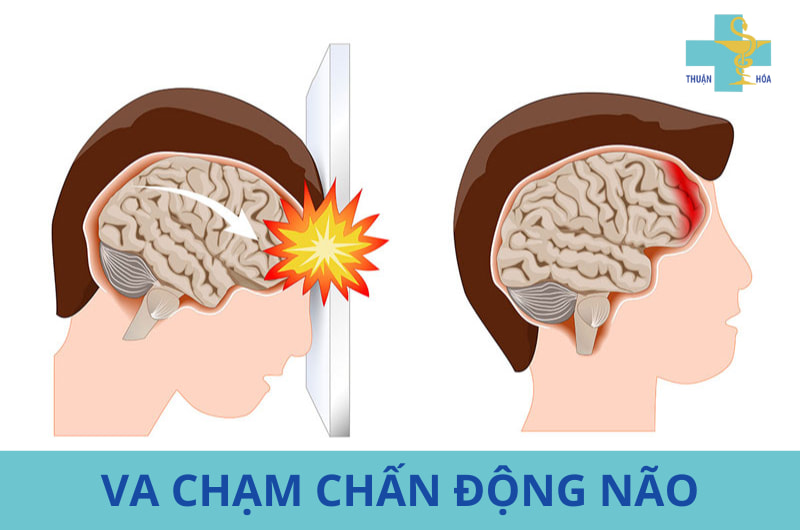 chấn thương đầu