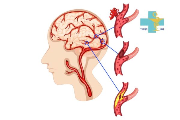 Nguyên nhân gây thiếu máu não