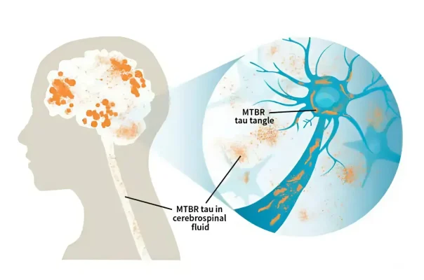 Bệnh Alzheimer