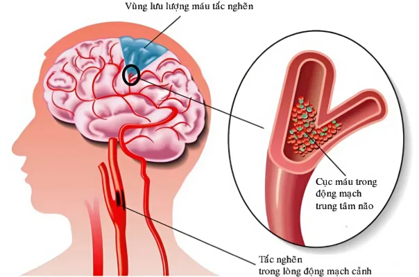 Rối loạn tuần hoàn não