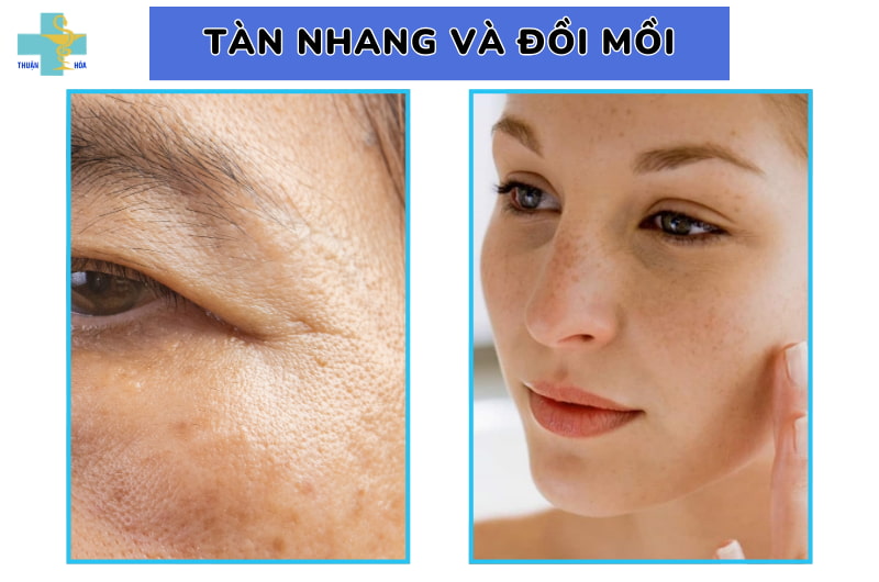 phân biệt tàn nhang và đồi mồi