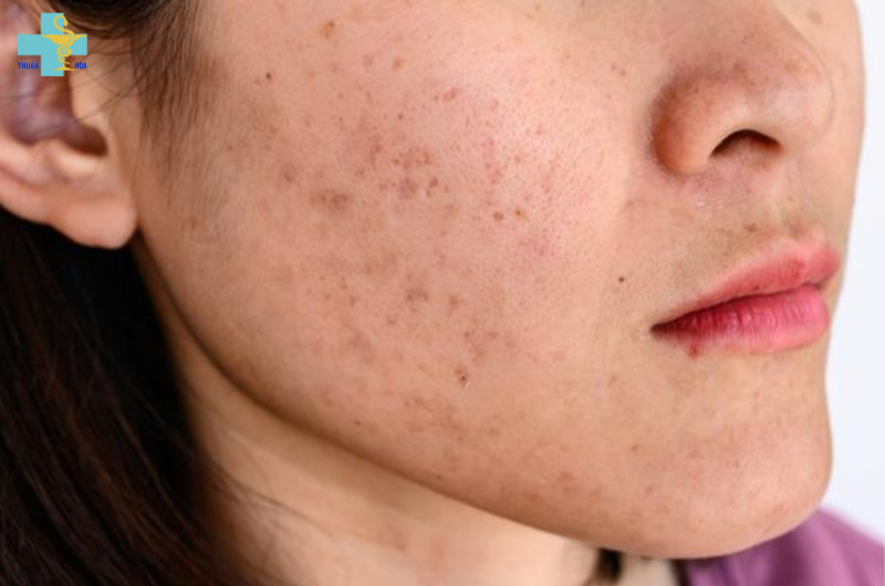 phân biệt tàn nhang và đồi mồi
