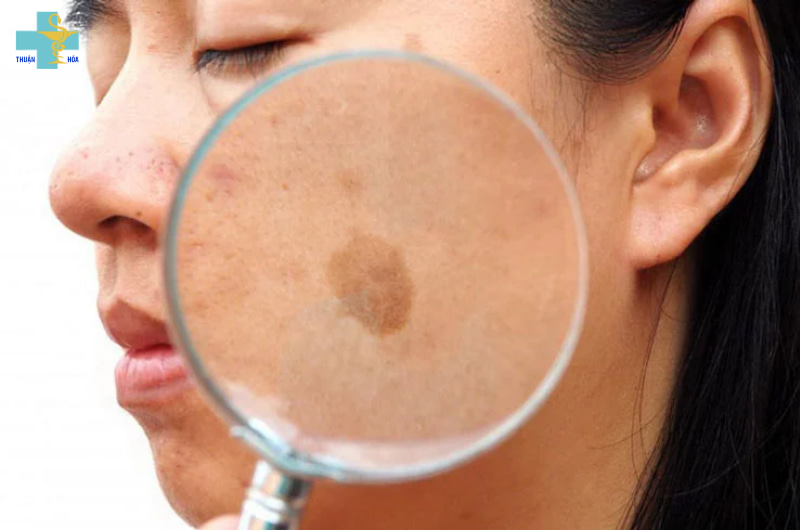 phân biệt tàn nhang và đồi mồi