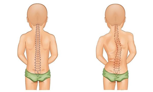Xương bị biến dạng